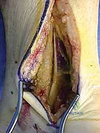 تصنيف هوكينز لكسور الكاحل