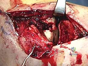 علاج تحفظي لكسر بسيط