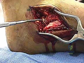 صورة طبية: كسر عظم الكاحل: الرد المفتوح والتثبيت الداخلي - دليل شامل من الأستاذ الدكتور محمد هطيف في صنعاء