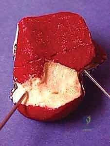 صورة طبية: كسر عظم الكاحل: الرد المفتوح والتثبيت الداخلي - دليل شامل من الأستاذ الدكتور محمد هطيف في صنعاء