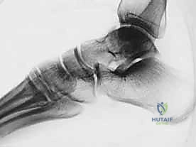 صورة طبية: كسر عظم الكاحل: الرد المفتوح والتثبيت الداخلي - دليل شامل من الأستاذ الدكتور محمد هطيف في صنعاء