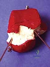 صورة توضيحية لـ كسر عظم الكاحل: الرد المفتوح والتثبيت الداخلي - دليل شامل من الأستاذ الدكتور محمد هطيف في صنعاء