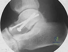 صورة طبية: كسر عظم الكاحل: الرد المفتوح والتثبيت الداخلي - دليل شامل من الأستاذ الدكتور محمد هطيف في صنعاء