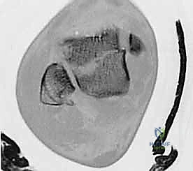 الشقوق الجراحية للكاحل