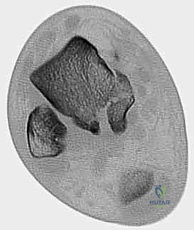 صورة توضيحية لـ كسر عظم الكاحل: الرد المفتوح والتثبيت الداخلي - دليل شامل من الأستاذ الدكتور محمد هطيف في صنعاء