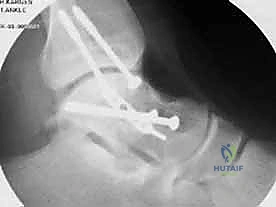 تنظيف ورد العظم