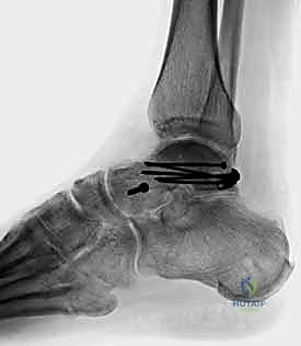 صورة طبية: كسر عظم الكاحل: الرد المفتوح والتثبيت الداخلي - دليل شامل من الأستاذ الدكتور محمد هطيف في صنعاء