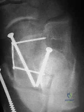 صورة توضيحية لـ كسر عظم الكاحل: الرد المفتوح والتثبيت الداخلي - دليل شامل من الأستاذ الدكتور محمد هطيف في صنعاء