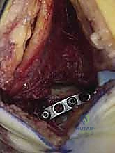 صورة توضيحية لـ كسر عظم الكاحل: الرد المفتوح والتثبيت الداخلي - دليل شامل من الأستاذ الدكتور محمد هطيف في صنعاء