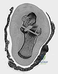 صورة طبية: كسر عظم الكاحل: الرد المفتوح والتثبيت الداخلي - دليل شامل من الأستاذ الدكتور محمد هطيف في صنعاء
