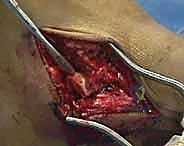 صورة توضيحية لـ كسر عظم الكاحل: الرد المفتوح والتثبيت الداخلي - دليل شامل من الأستاذ الدكتور محمد هطيف في صنعاء