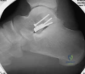 صورة توضيحية لـ كسر عظم الكاحل: الرد المفتوح والتثبيت الداخلي - دليل شامل من الأستاذ الدكتور محمد هطيف في صنعاء
