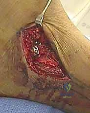 استخدام مسامير التيتانيوم