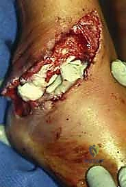 صورة توضيحية لـ كسر عظم الكاحل: الرد المفتوح والتثبيت الداخلي - دليل شامل من الأستاذ الدكتور محمد هطيف في صنعاء