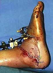 صورة طبية: كسر عظم الكاحل: الرد المفتوح والتثبيت الداخلي - دليل شامل من الأستاذ الدكتور محمد هطيف في صنعاء