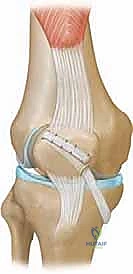 إصلاح وإعادة بناء الرباط الرضفي الفخذي الإنسي (MPFL): الحل الفعال لعدم استقرار الرضفة مع الأستاذ الدكتور محمد هطيف