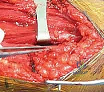 كسر عظم العضد: دليل شامل لتثبيت الشريحة الجراحي والتعافي مع الأستاذ الدكتور محمد هطيف