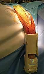 تطبيق الجبائر الوظيفية في العلاج التحفظي