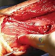 صورة توضيحية لـ كسر عظم العضد: دليل شامل لتثبيت الشريحة الجراحي والتعافي مع الأستاذ الدكتور محمد هطيف