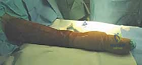 تجهيز المريض والتخدير قبل الجراحة