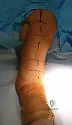 Mastering Humeral Shaft Fixation: An Intraoperative Guide to Plate Osteosynthesis