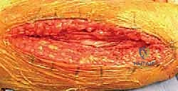 صورة توضيحية لـ كسر عظم العضد: دليل شامل لتثبيت الشريحة الجراحي والتعافي مع الأستاذ الدكتور محمد هطيف