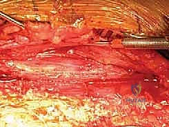 صورة توضيحية لـ كسر عظم العضد: دليل شامل لتثبيت الشريحة الجراحي والتعافي مع الأستاذ الدكتور محمد هطيف