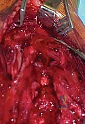 صورة طبية: كسر عظم العضد: دليل شامل لتثبيت الشريحة الجراحي والتعافي مع الأستاذ الدكتور محمد هطيف