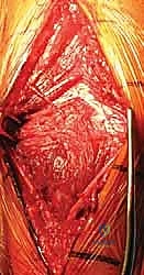 صورة توضيحية لـ كسر عظم العضد: دليل شامل لتثبيت الشريحة الجراحي والتعافي مع الأستاذ الدكتور محمد هطيف