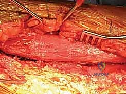 صورة توضيحية لـ كسر عظم العضد: دليل شامل لتثبيت الشريحة الجراحي والتعافي مع الأستاذ الدكتور محمد هطيف