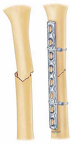 صورة توضيحية لـ كسر عظم العضد: دليل شامل لتثبيت الشريحة الجراحي والتعافي مع الأستاذ الدكتور محمد هطيف