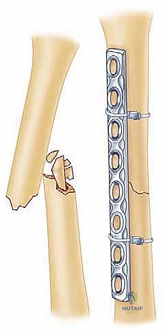 التخطيط الجراحي لحالات الكسور المعقدة