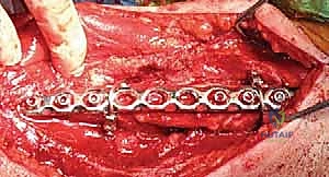 التشريح الدقيق لعظم العضد وموقع الكسر