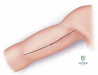 صورة توضح العلاقة بين العصب الكعبري وعظم العضد