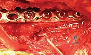صورة طبية: كسر عظم العضد: دليل شامل لتثبيت الشريحة الجراحي والتعافي مع الأستاذ الدكتور محمد هطيف