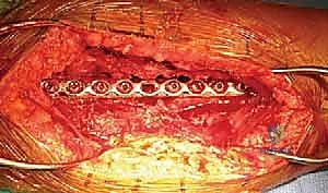 أنواع الشرائح الجراحية المستخدمة في تثبيت العضد