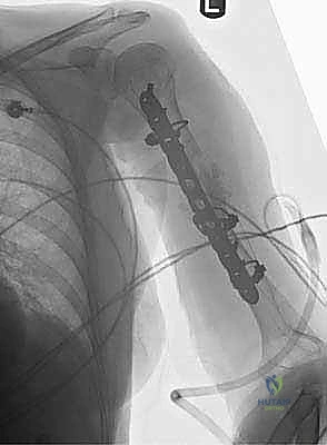 أسباب وآليات حدوث كسور العضد المختلفة