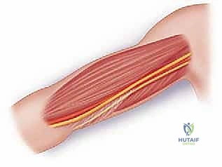 صورة طبية: كسر عظم العضد: دليل شامل لتثبيت الشريحة الجراحي والتعافي مع الأستاذ الدكتور محمد هطيف