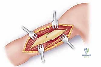 صورة طبية: كسر عظم العضد: دليل شامل لتثبيت الشريحة الجراحي والتعافي مع الأستاذ الدكتور محمد هطيف