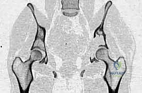 تخطيط جراحي متقدم لأورام الحوض