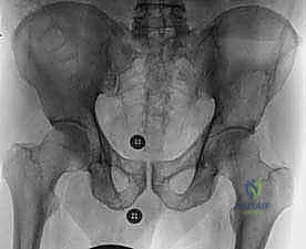 تأثير الأورام على تجويف الحق