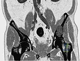 تقييم حالة العظام قبل الجراحة