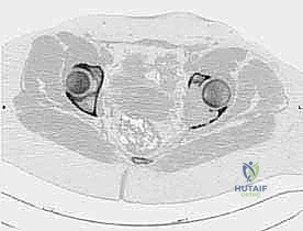 إعادة بناء الحوض باستخدام التقنيات المتقدمة