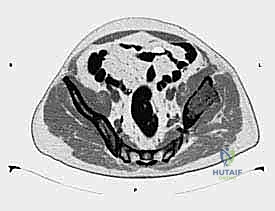صور أشعة توضح تآكل العظام الحوضية