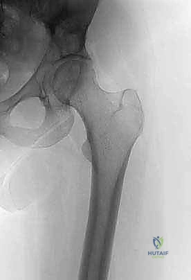 تثبيت الحوض جراحياً