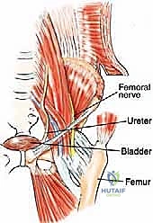 التشخيص الدقيق لأورام الحوض النقيلية