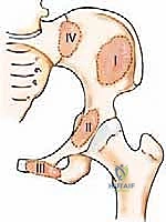 Surgical Management of Metastatic Bone Disease: Pelvic Lesions