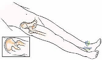 صورة توضيحية لـ جراحة أورام العظام النقيلية في الحوض: دليل شامل للمرضى مع الأستاذ الدكتور محمد هطيف