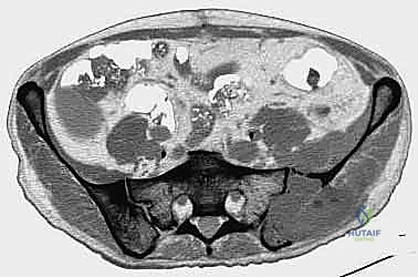 تحليل الأنسجة السرطانية في العظام