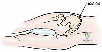 صورة توضيحية لـ جراحة أورام العظام النقيلية في الحوض: دليل شامل للمرضى مع الأستاذ الدكتور محمد هطيف